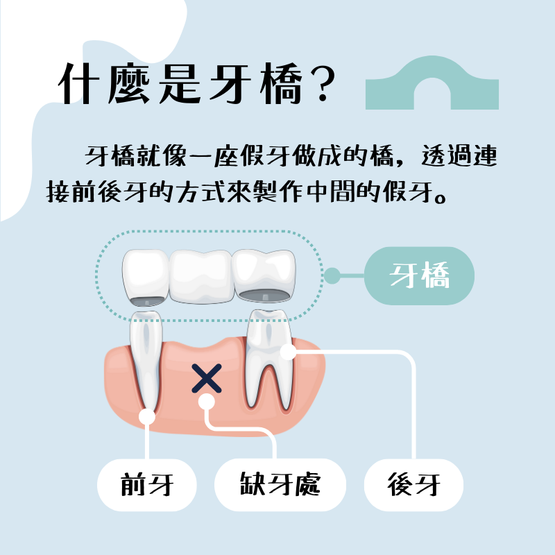 什麼是牙橋