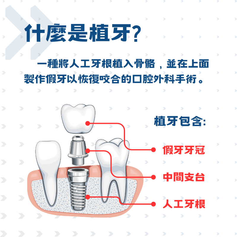 什麼是植牙一張圖就懂